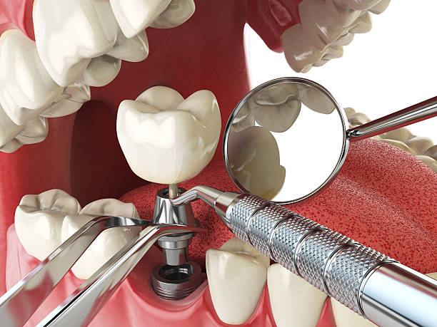 Best Broken or Cracked Tooth Emergency Dentist in Larchmont, NY