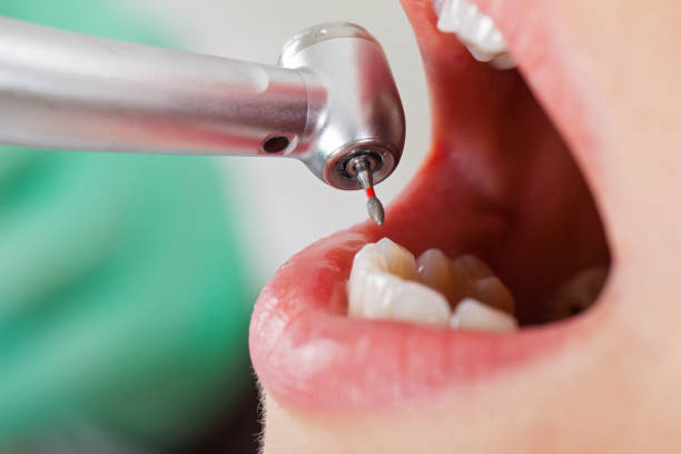 Best Emergency Dentist for Lost Fillings or Crowns in Larchmont, NY